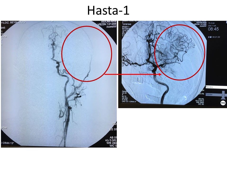 BOLU SAĞLIKTA İLKLERE İMZA ATMAYA DEVAM EDİYOR