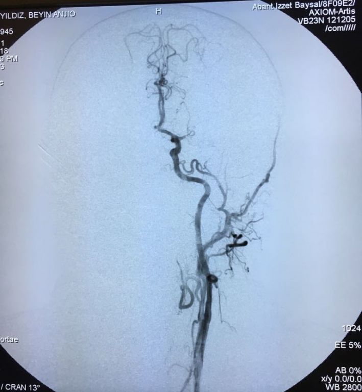 BOLU SAĞLIKTA İLKLERE İMZA ATMAYA DEVAM EDİYOR