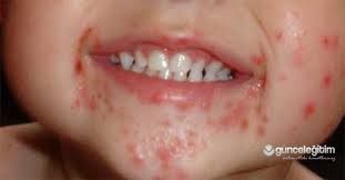 EL, AYAK, AĞIZ HASTALIĞINA DİKKAT