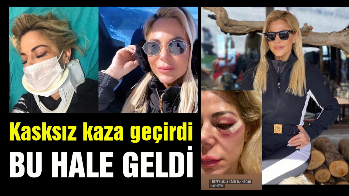 Ünlü sima Kartalkaya'da kasksız kaza geçirdi