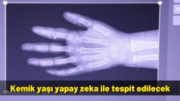 Kemik yaşı yapay zeka ile tespit edilecek